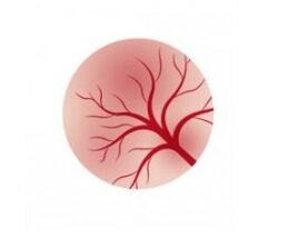 Inflammation of the bladder mucosa and treatment with female capsules